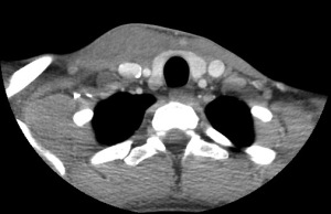 neck mass CT