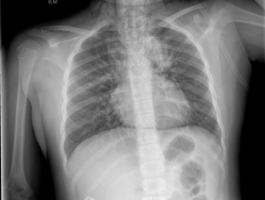 FRS CXR