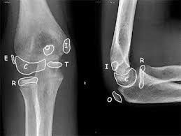 Elbow ossification centers